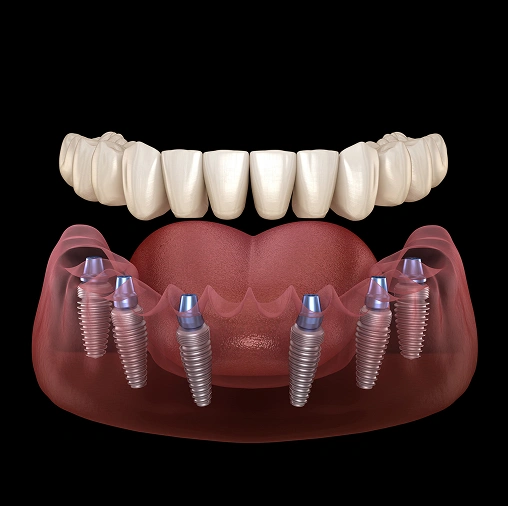 Dental implants with prosthetic teeth crown on dark background showing surgical placement.