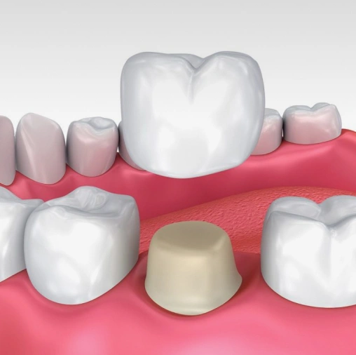 3D dental illustration showing crown placement on tooth model with pink gums and adjacent teeth.