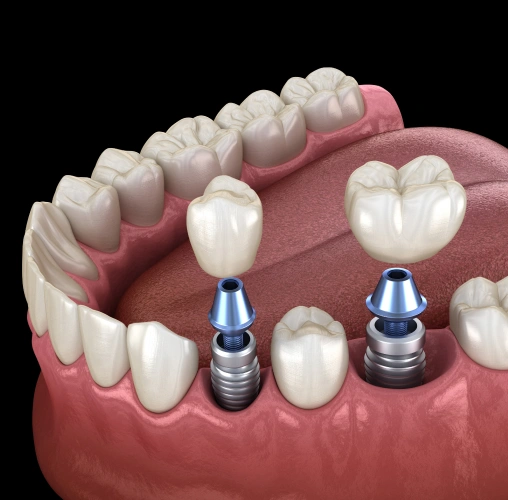 Dental implants illustrated in jawbone model showing implant posts and crowns placement