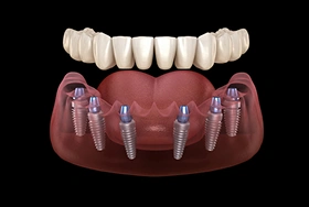 Dental implants model showing full arch prosthetic teeth on implant fixtures against black background.
