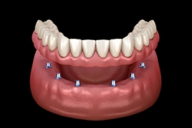 Dental implant model showing prosthetic teeth attached to lower jaw with four implant anchors.