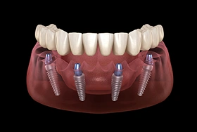 Dental implants model showing four titanium screws supporting upper teeth prosthesis on gum.