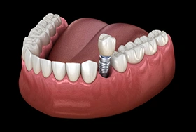Dental implant model showing tooth replacement in gum tissue with prosthetic crown and abutment.