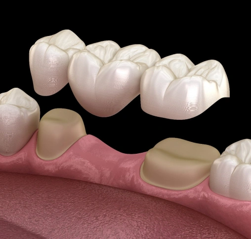 Dental bridge restoration showing porcelain crowns attached to pink gum model for implant placement visualization.