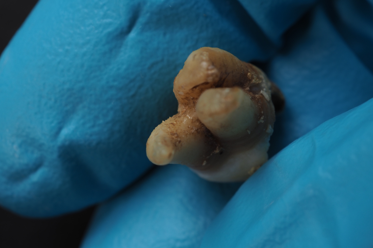 Tooth Extraction Procedure