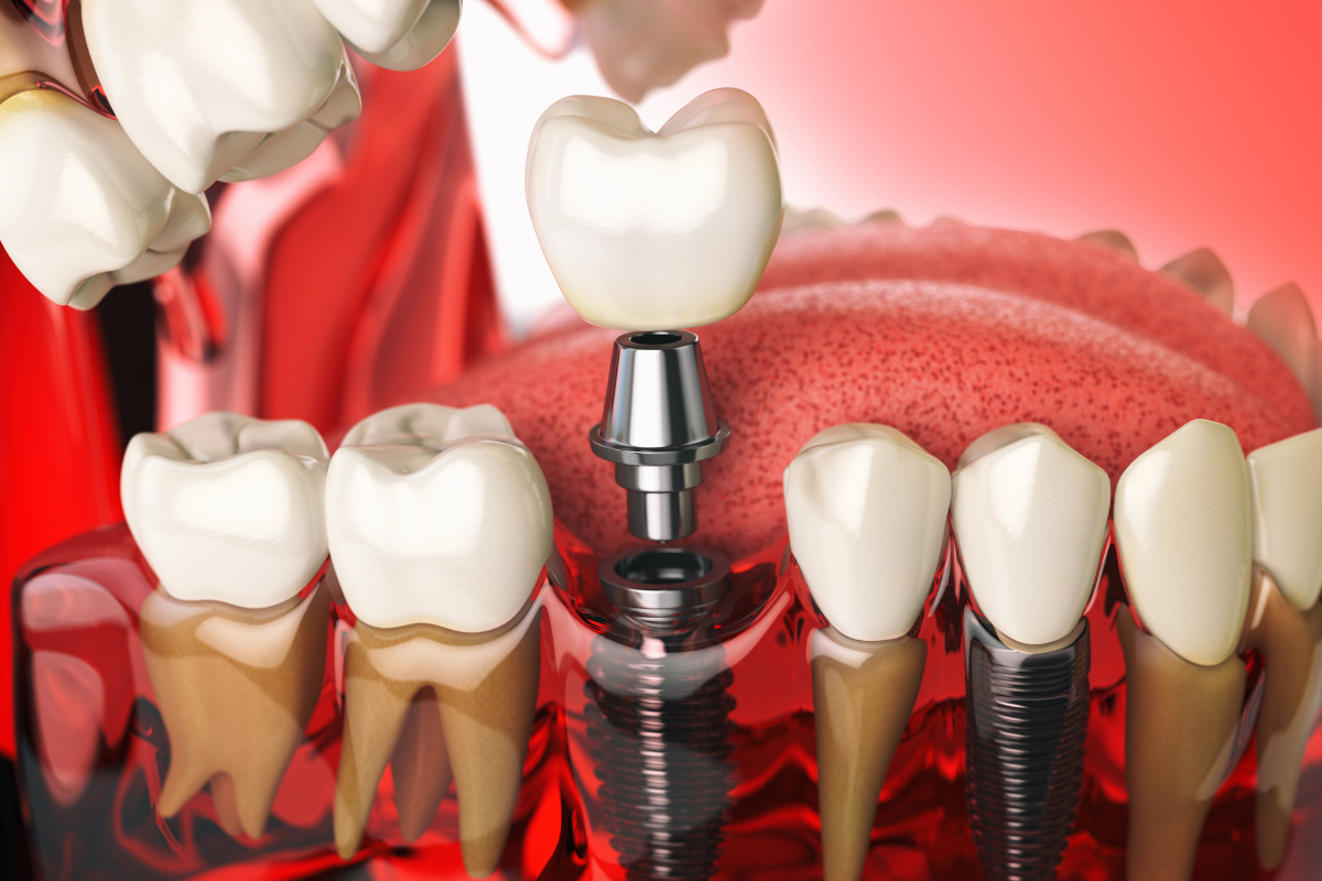 dental implants treatment