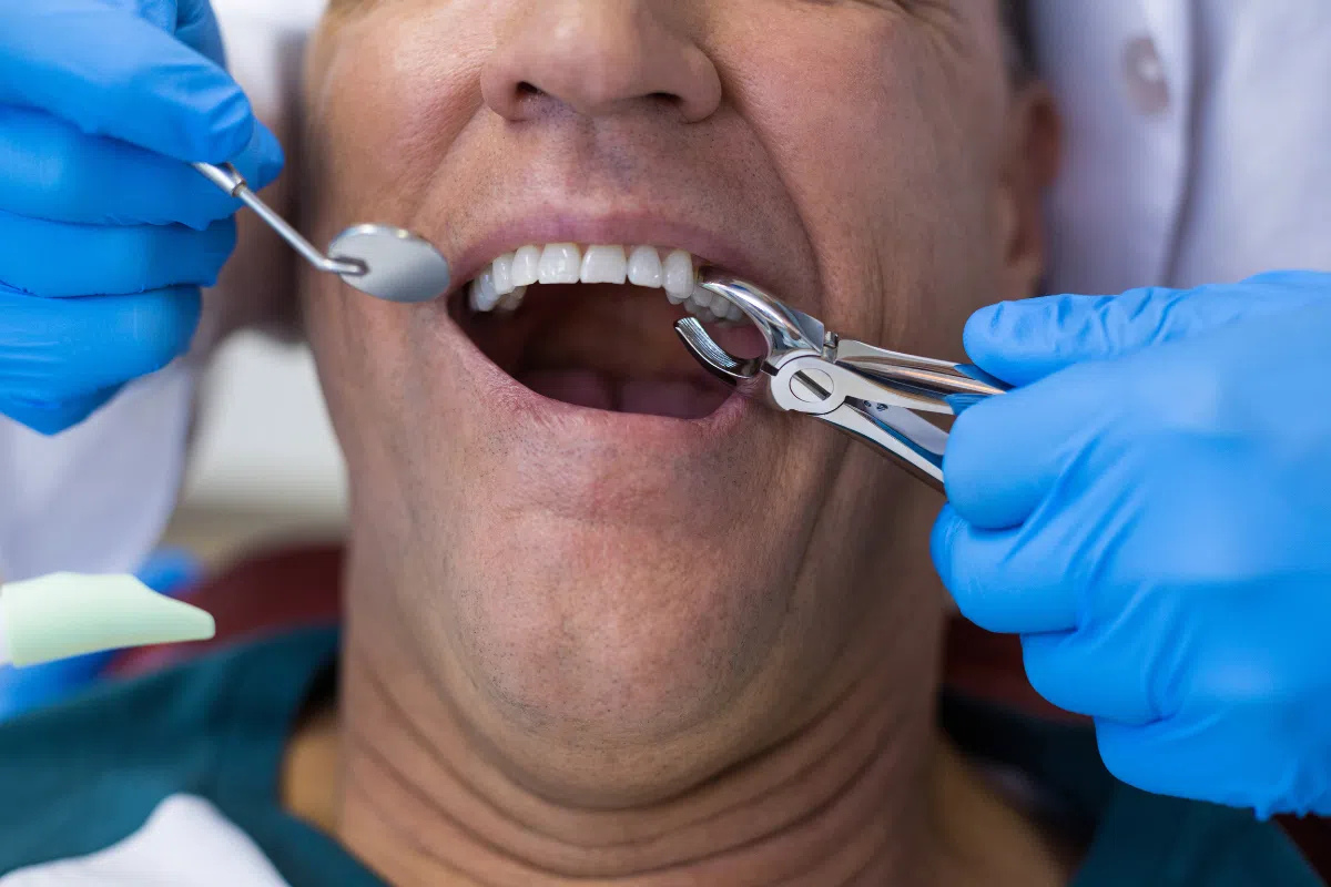 Tooth Extractions for oral health