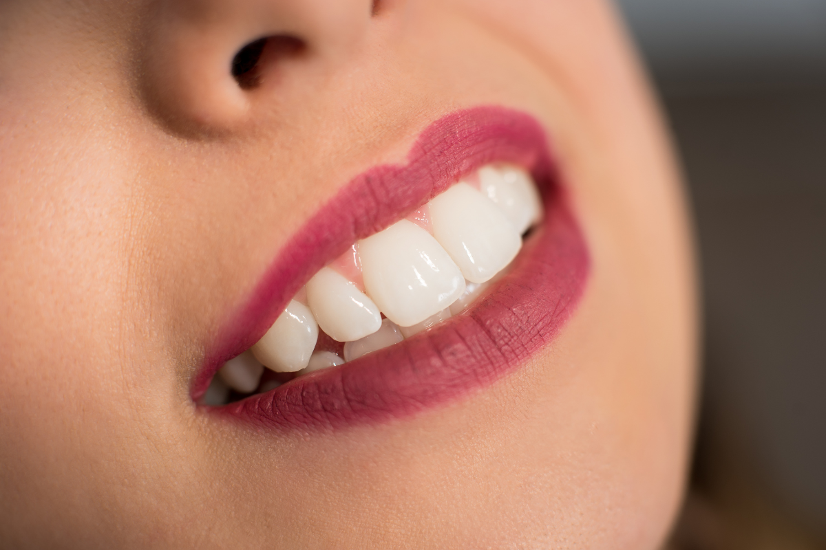 teeth whitening procedure