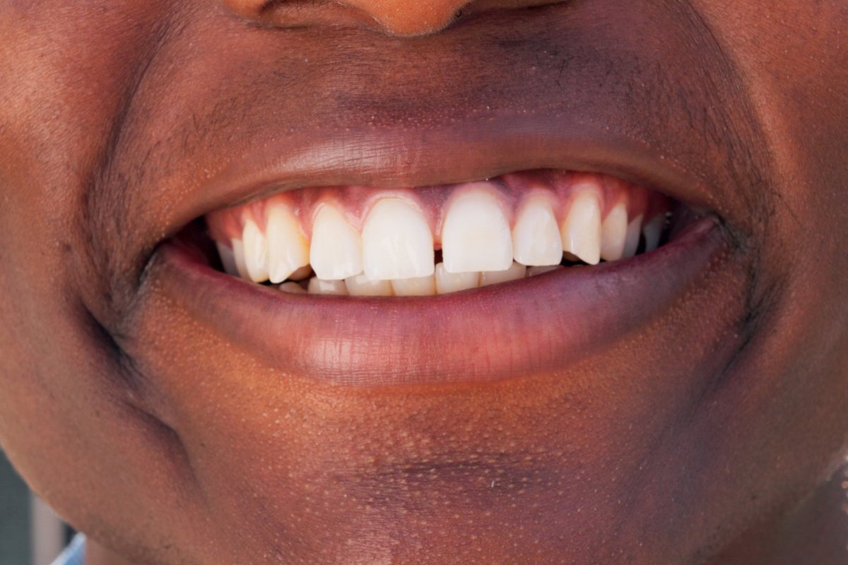 cosmetic dentistry lasting result