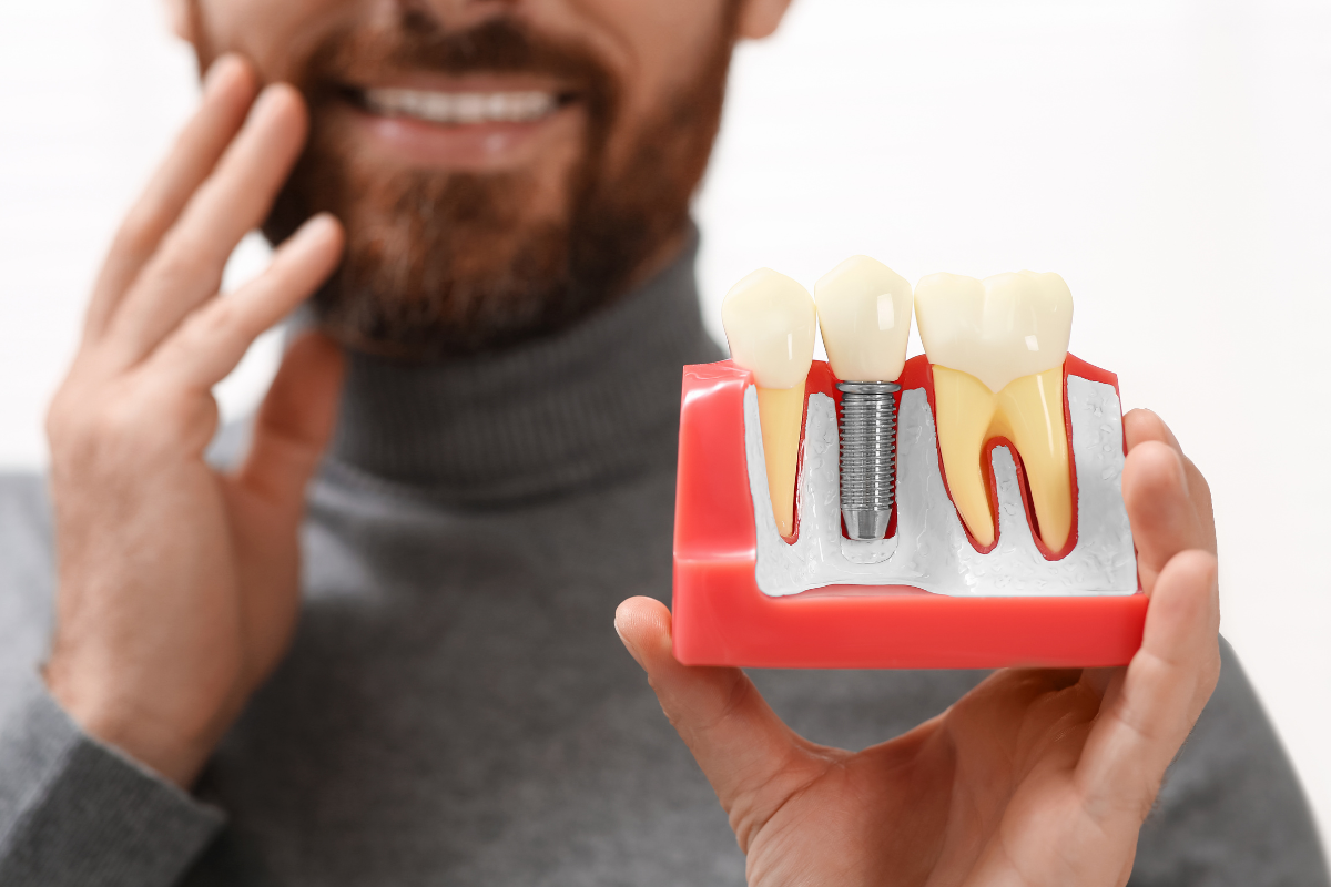 Dental Implants for Missing Teeth