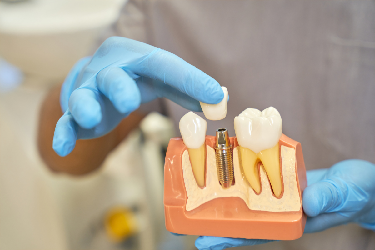 Dental implants for missing teeth